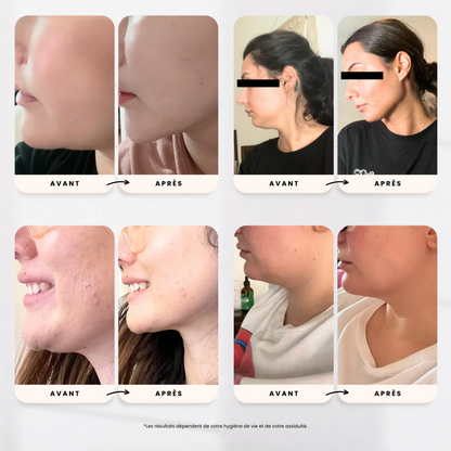 Sculpt Face SKINLIFT™
